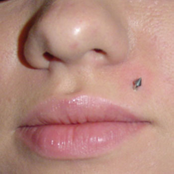 piercing infection. This kind of lip piercing is