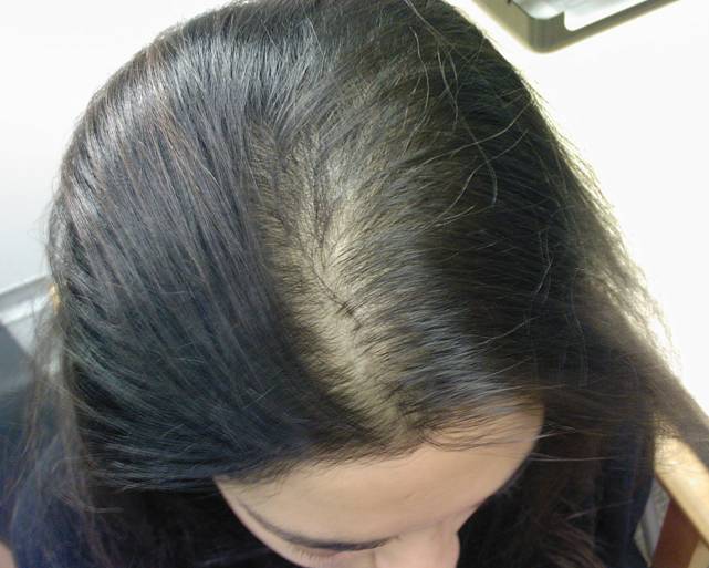Pattern I: Thinning of the hair on the central scalp.