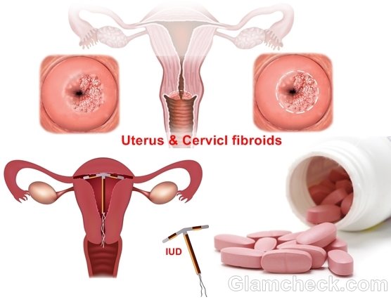 causes of irregular periods and spotting
