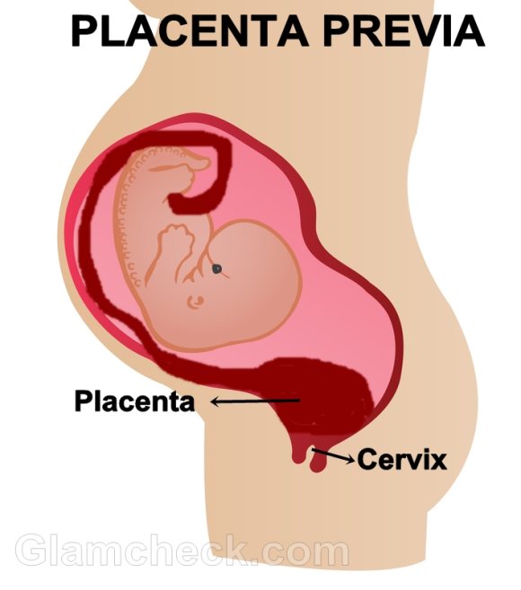 placenta-previa-pregnancy-complication