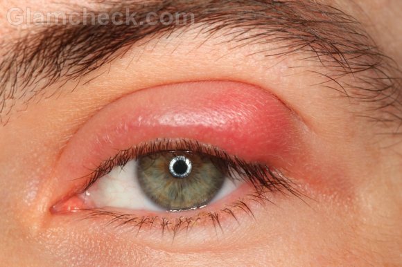 Stye eye infection