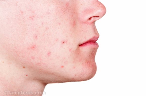 How to Get Rid of Pimple Scars?