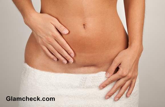 Natural Remedies to Get Rid Of C-Section Scars