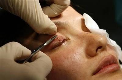 Blepharoplasty / eyelid surgery  (2)