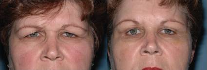 Blepharoplasty before after