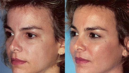 Cheek augmentation / cheek implant