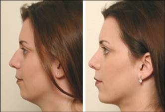 Chin augmentation before after