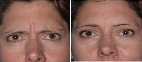 Eyebrow lift before after