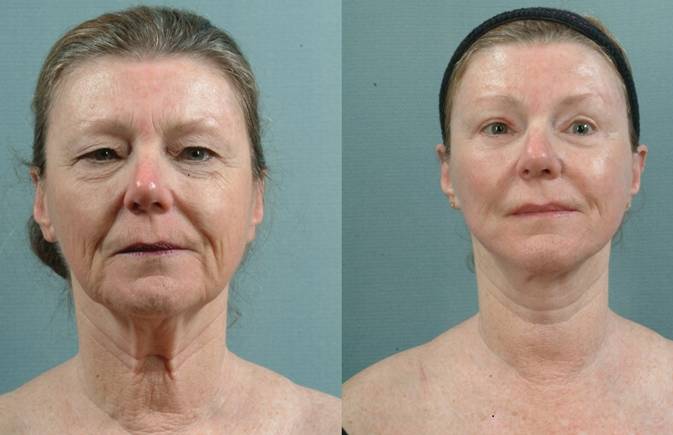Face lift before after