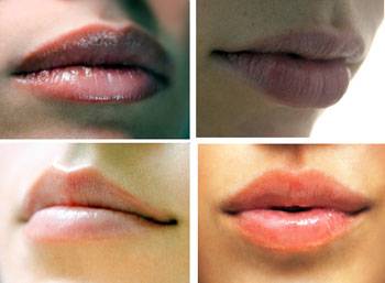 Lip augmentation / lip enhancement 