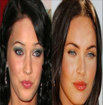 Lip augmentation before after