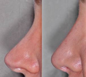 Rhinoplasty before after