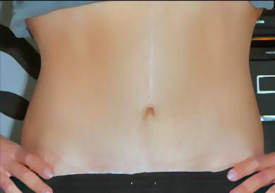 Tummy tuck (3)