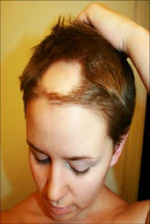 Alopecia Areata