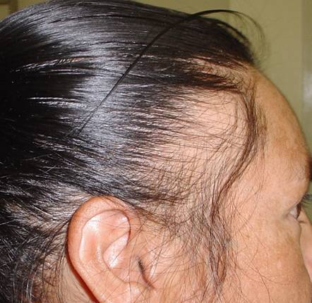 Traction alopecia