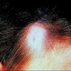 Triangular alopecia