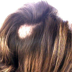 Trichotillomania