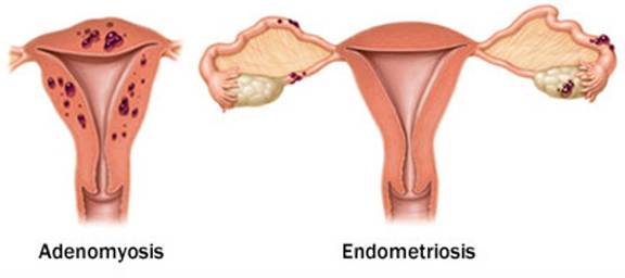 Endometriosis and adenomyosis cause blood clots