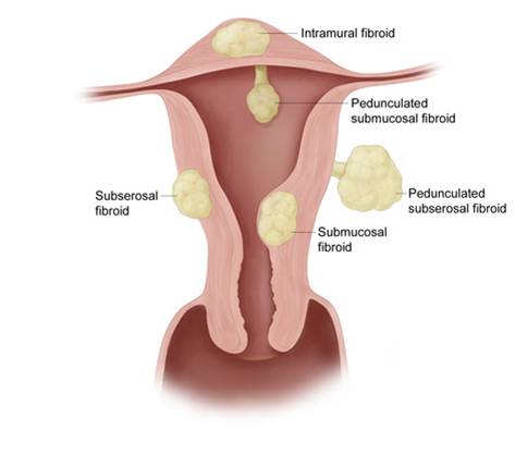 Uterus fibroids