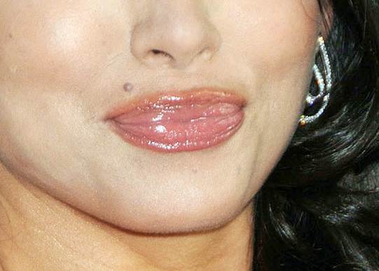 Stephanie Jacobsen lip agumentation gone wrong