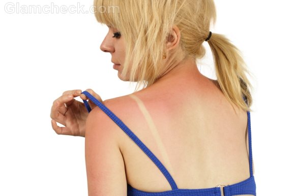 How to prevent sunburn