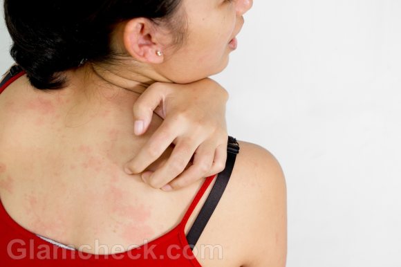 Skin rashes Causes Symptoms Treatment
