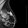 Breast density associated with breast cancer