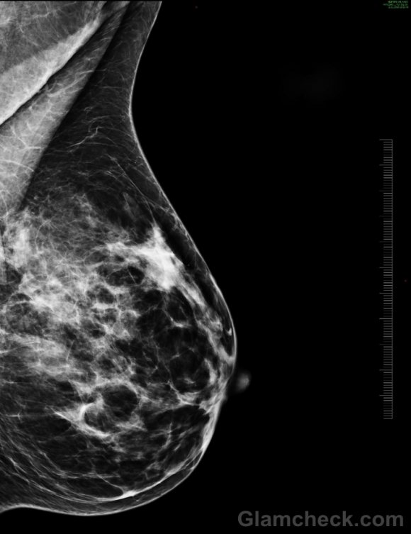 Breast density associated with breast cancer