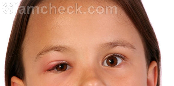 Blepharitis eye infection