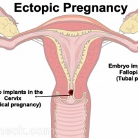 Ectopic pregnancy complications