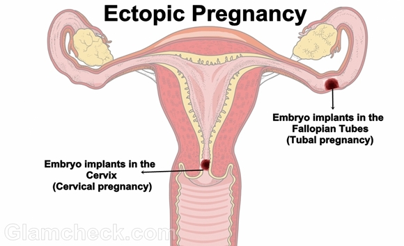 Ectopic pregnancy complications