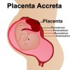 Placenta Accreta Placental Pregnancy Complication