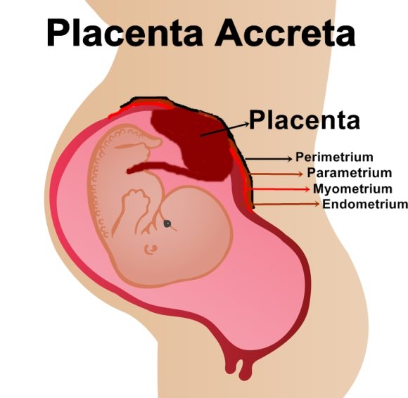 Placenta Accreta Placental Pregnancy Complication