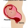 Placenta Previa pregnancy complication