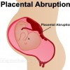 Placental Abruption Placental Pregnancy Complication