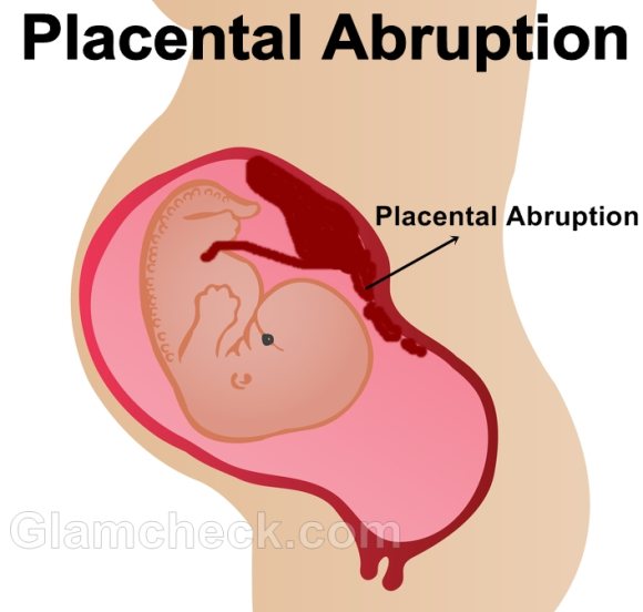 Placental Abruption Placental Pregnancy Complication