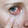 eye infections types