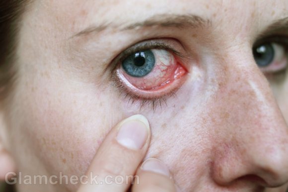 eye infections types