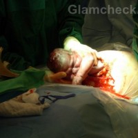 Caesarean Section Delivery