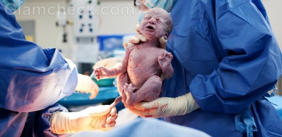 Caesarean Section Delivery baby birth