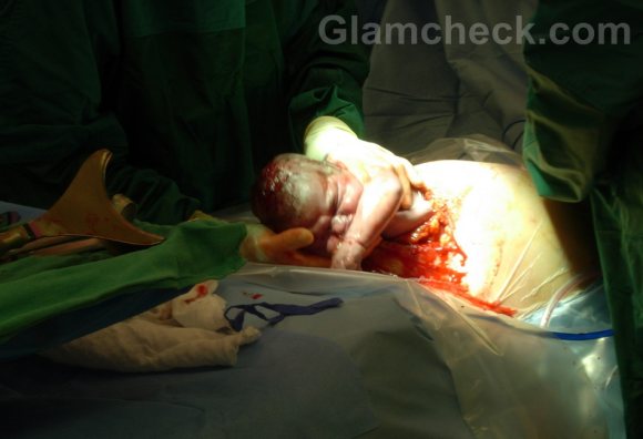 Caesarean Section Delivery