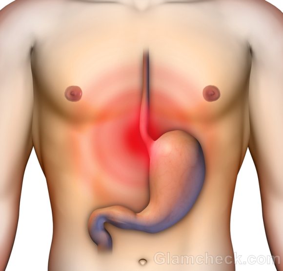 Heartburn acid reflux