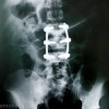 Spine Surgery Lowers Vitamin D