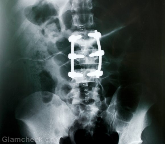 Spine Surgery Lowers Vitamin D