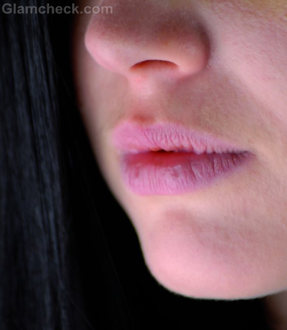 Cracked Lips Causes Symptoms and Treatment