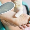 cracked heels causes treatment