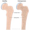 Early Bone Growth Determines Bone Density Later in Life