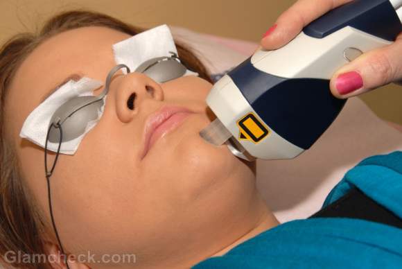 Laser scar therapy