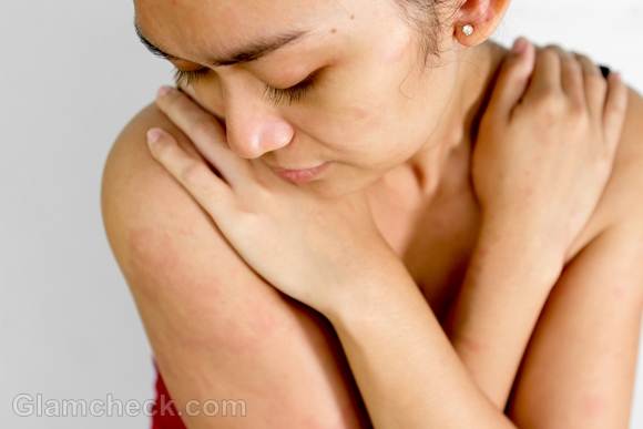 Pregnancy Rashes